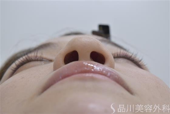 症例NO.51781のBEFORE写真