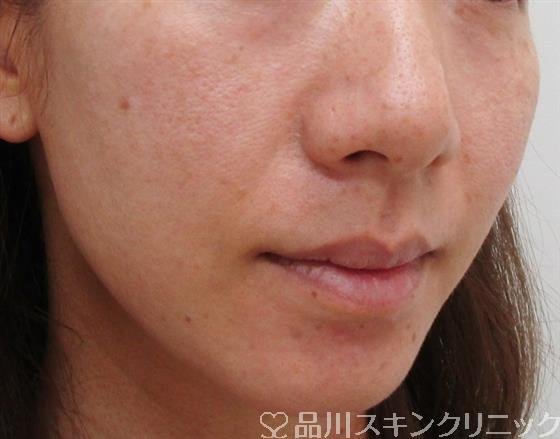 症例NO.42834のAFTER写真