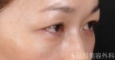 症例NO.71521のBEFORE写真