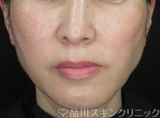 症例NO.70364のBEFORE写真