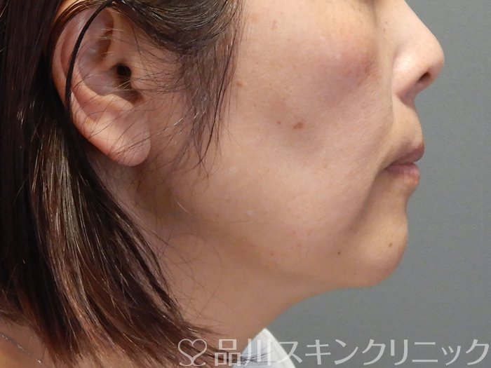 症例NO.69479のBEFORE写真