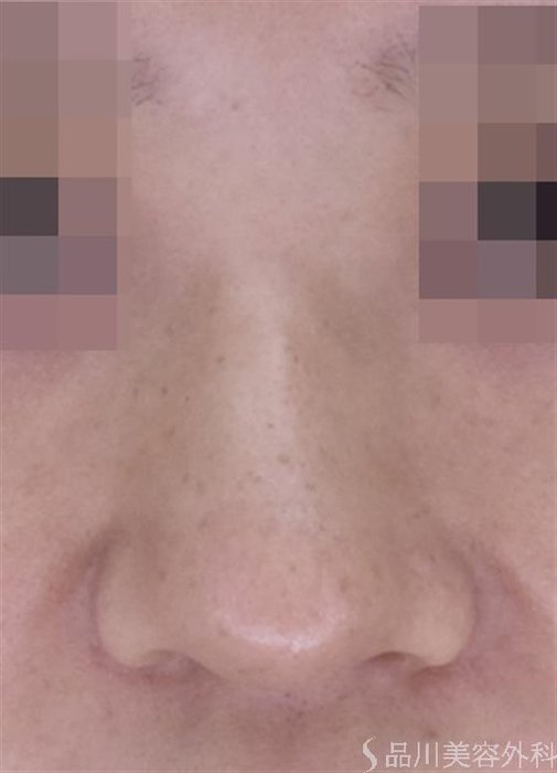 症例NO.51562のBEFORE写真