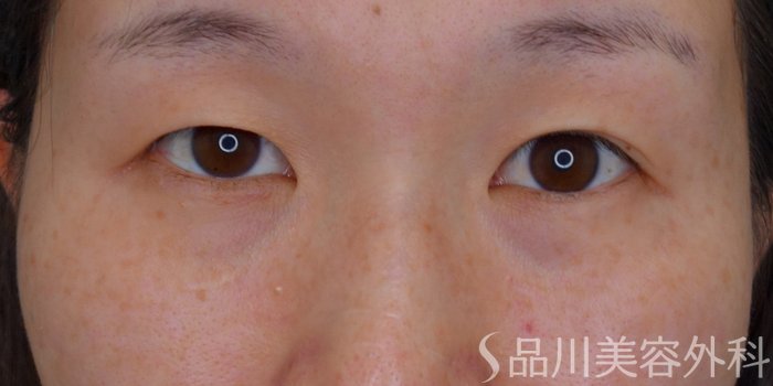 症例NO.74543のBEFORE写真