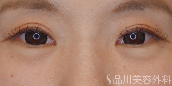 症例NO.69620のAFTER写真