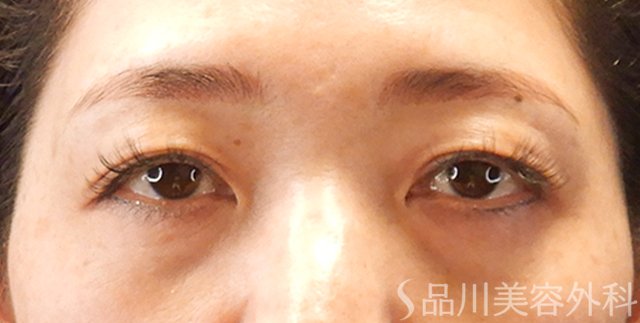 症例NO.70617のBEFORE写真