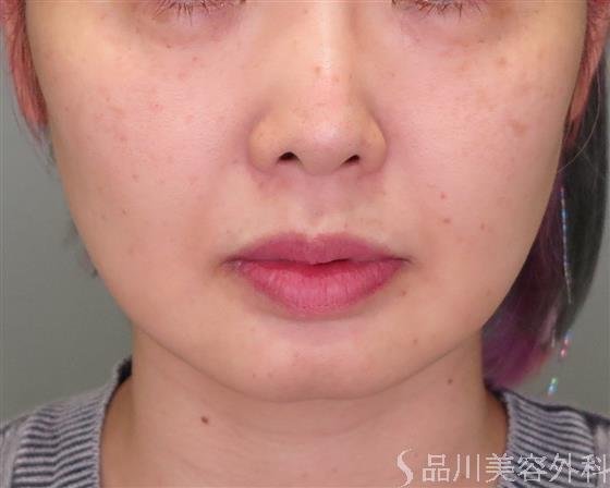 症例NO.48849のBEFORE写真