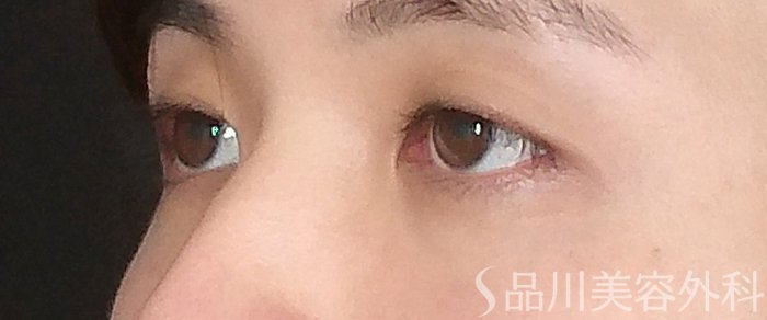 症例NO.72308のBEFORE写真