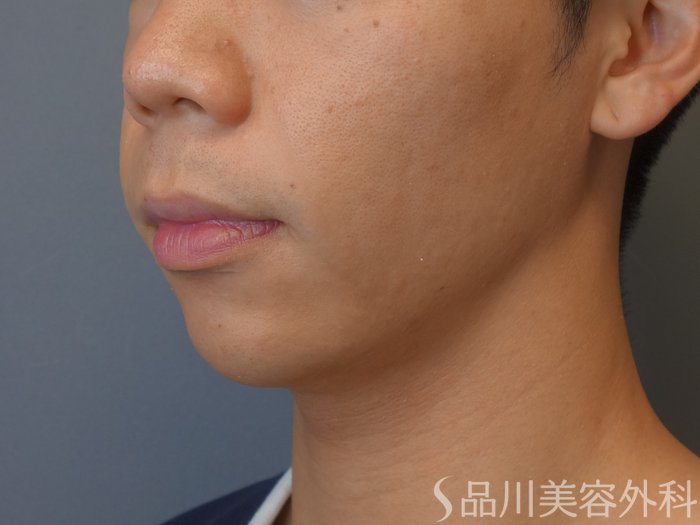 症例NO.74994のBEFORE写真