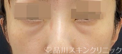 症例NO.62588のBEFORE写真