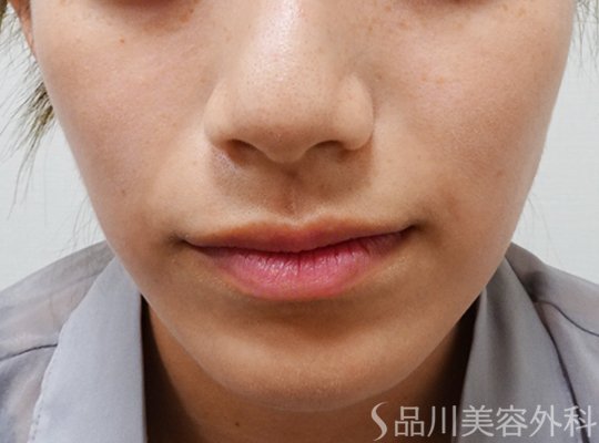 症例NO.68022のAFTER写真