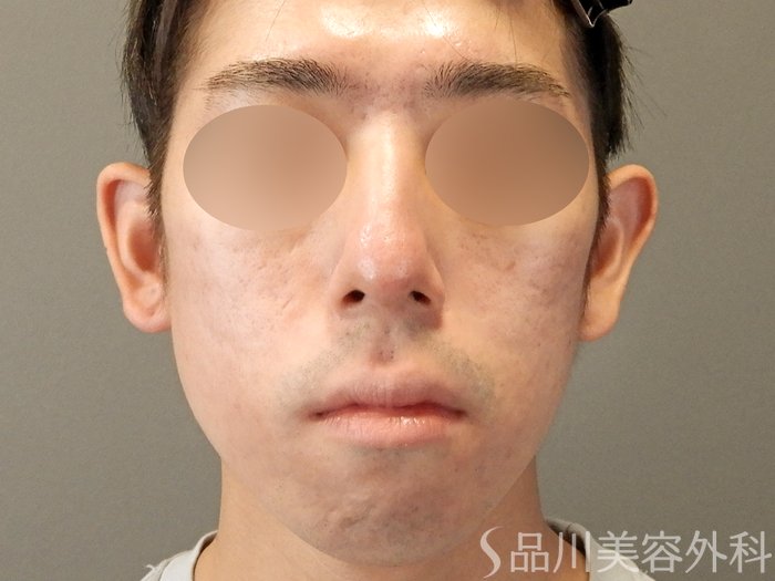 症例NO.67619のAFTER写真