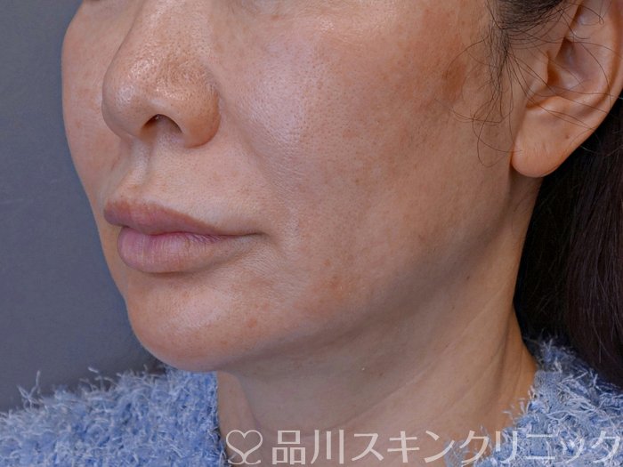 症例NO.73994のBEFORE写真