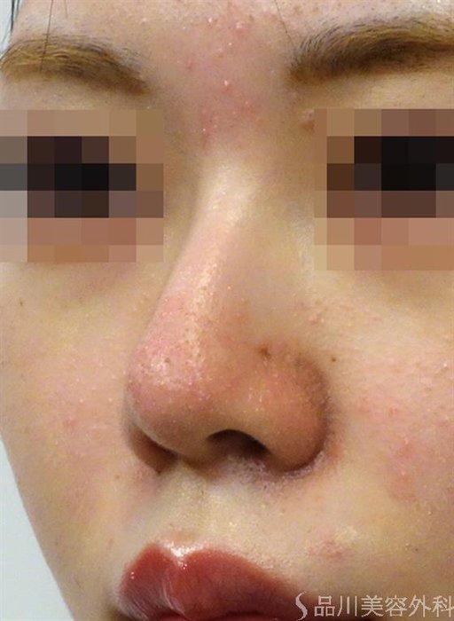 症例NO.38561のBEFORE写真