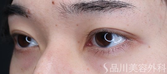 症例NO.69452のAFTER写真