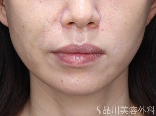 症例NO.73913のAFTER写真
