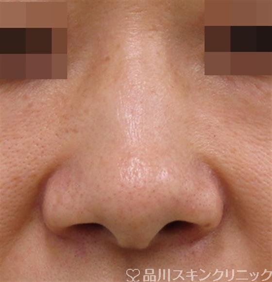 症例NO.38476のBEFORE写真