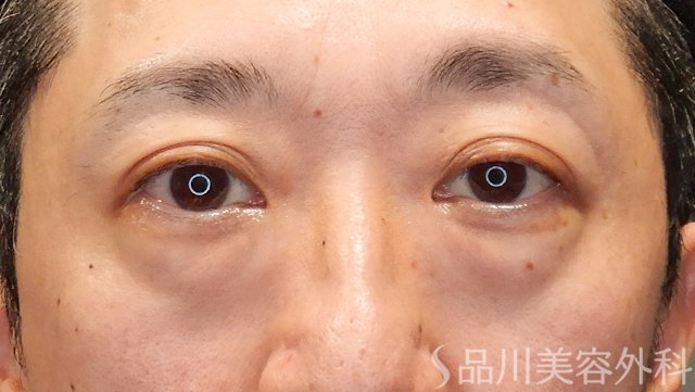 症例NO.74560のBEFORE写真