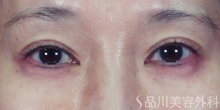 症例NO.70352のAFTER写真