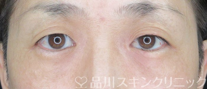 症例NO.62787のBEFORE写真