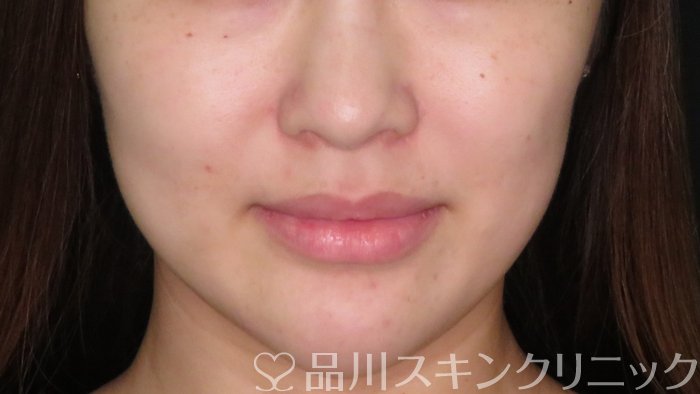 症例NO.71011のBEFORE写真