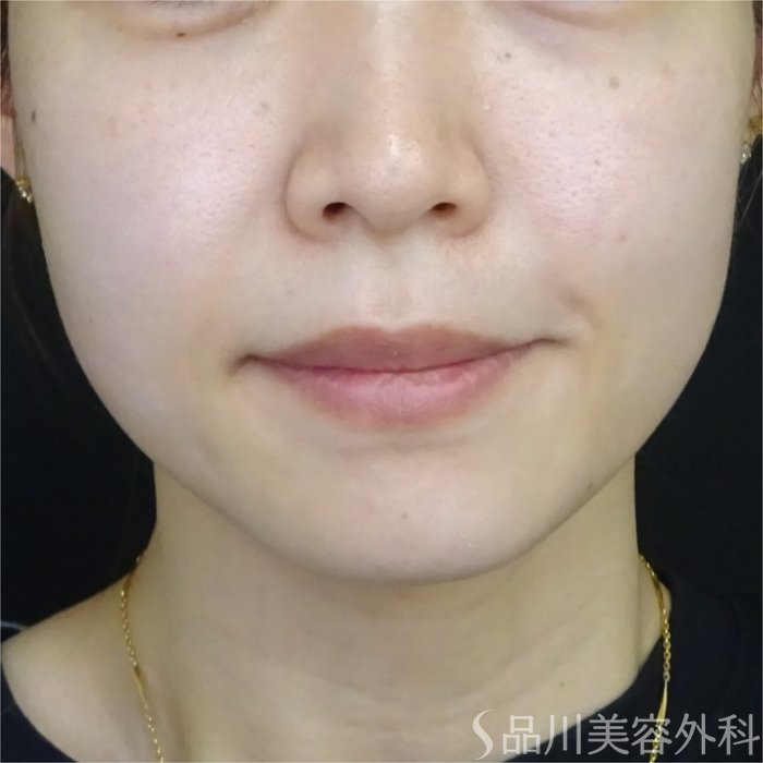 症例NO.69693のBEFORE写真