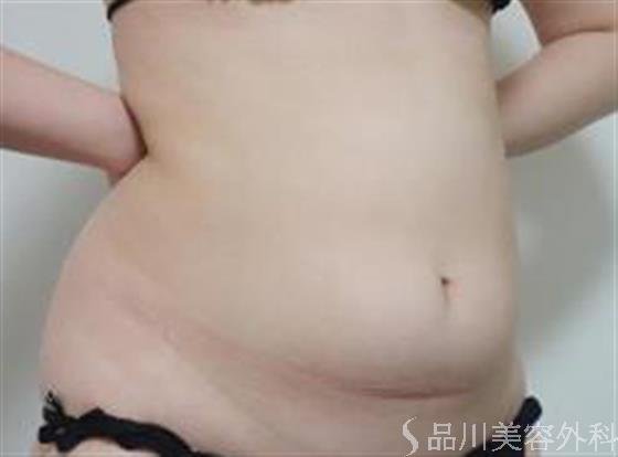 症例NO.23178のBEFORE写真