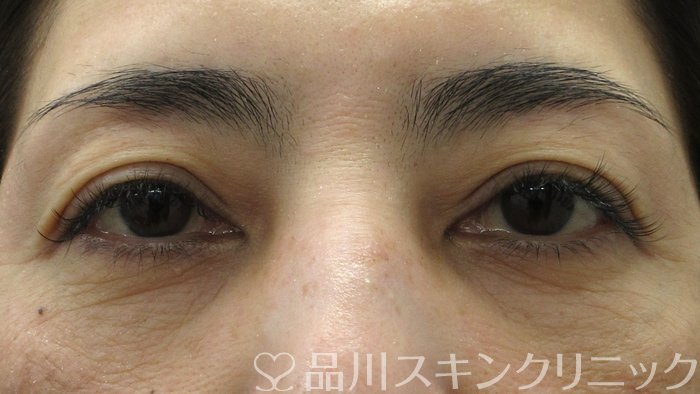 症例NO.74354のAFTER写真