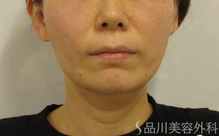 症例NO.73643のAFTER写真