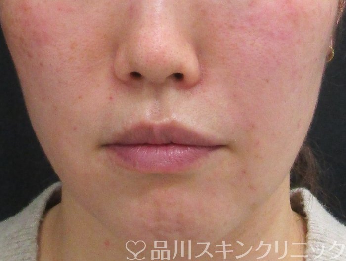 症例NO.69938のAFTER写真