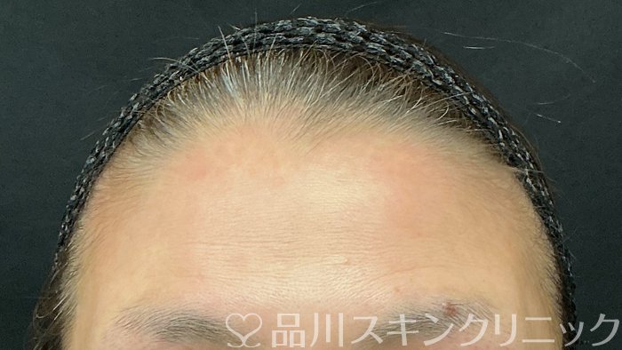 症例NO.74874のBEFORE写真