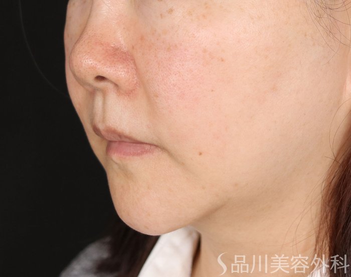 症例NO.73117のBEFORE写真