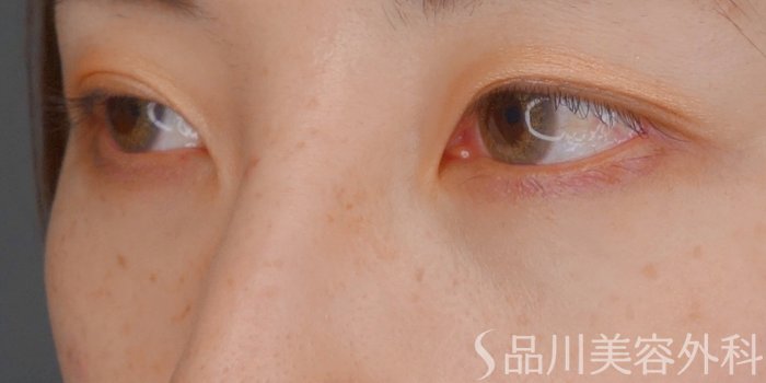 症例NO.64817のAFTER写真