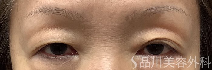 症例NO.62218のBEFORE写真