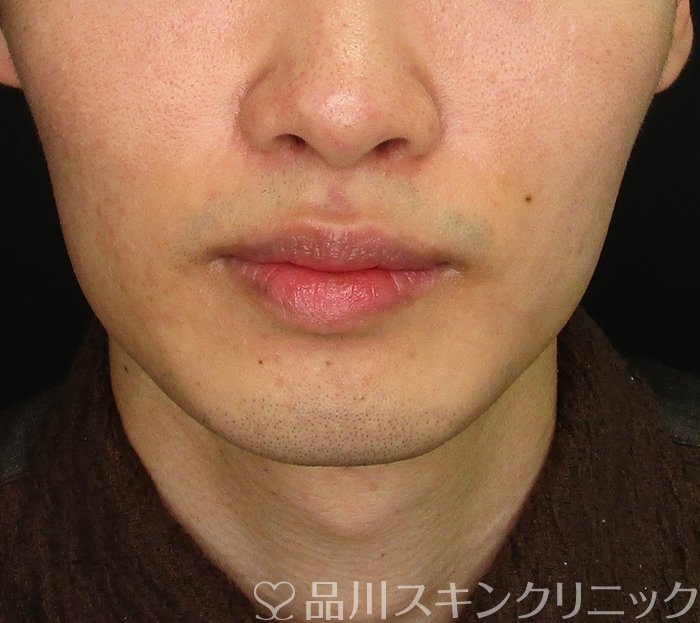 症例NO.70339のAFTER写真