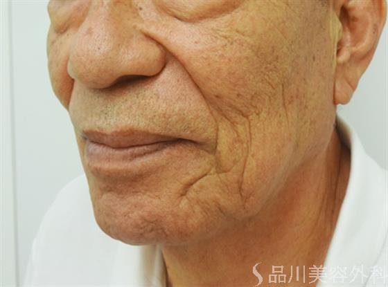 症例NO.30975のAFTER写真