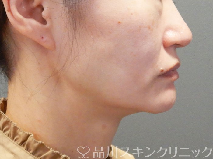 症例NO.72393のBEFORE写真