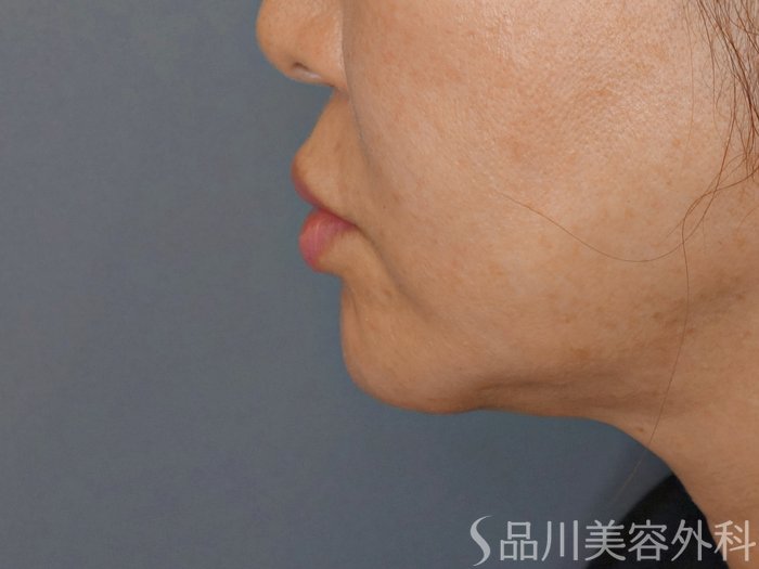 症例NO.70948のBEFORE写真