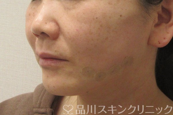 症例NO.74163のAFTER写真