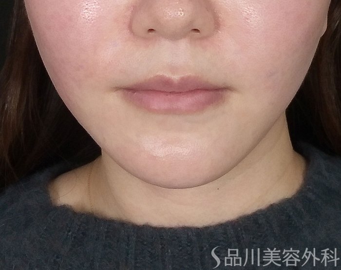 症例NO.73392のAFTER写真