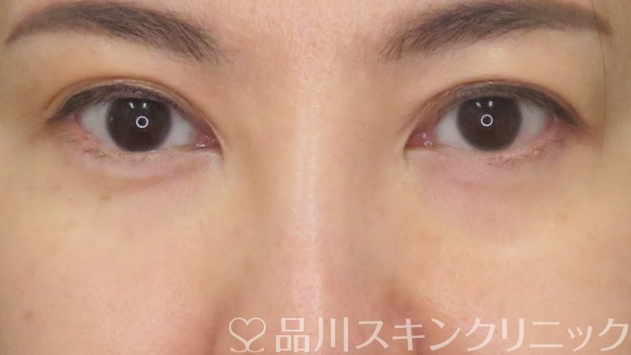 症例NO.71851のBEFORE写真