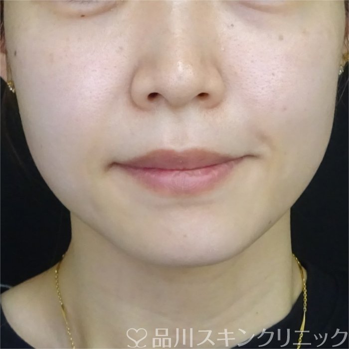症例NO.69693のBEFORE写真