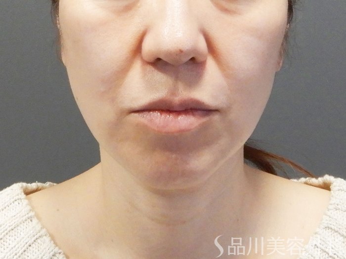 症例NO.75075のAFTER写真