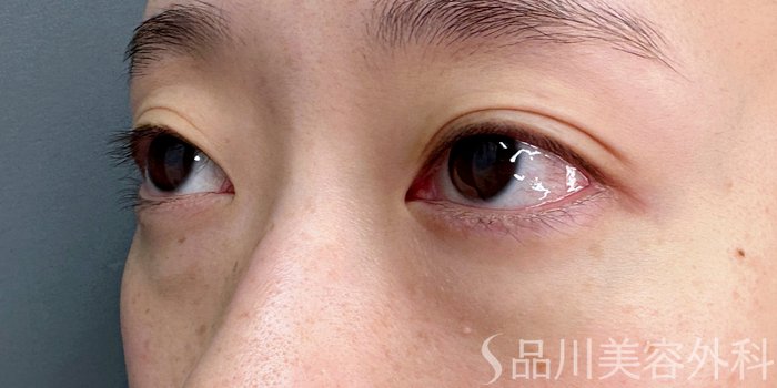 症例NO.74760のBEFORE写真