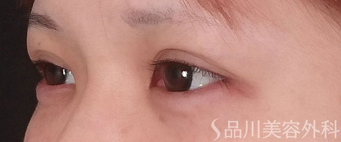 症例NO.69623のAFTER写真