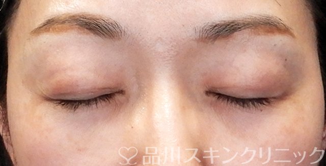 症例NO.68898のAFTER写真