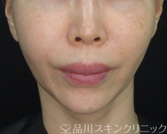 症例NO.74449のBEFORE写真
