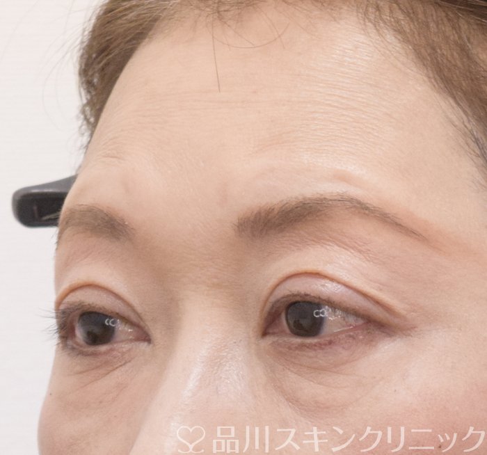 症例NO.74052のAFTER写真