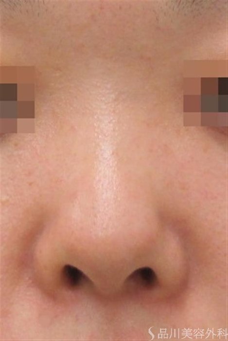 症例NO.23856のBEFORE写真