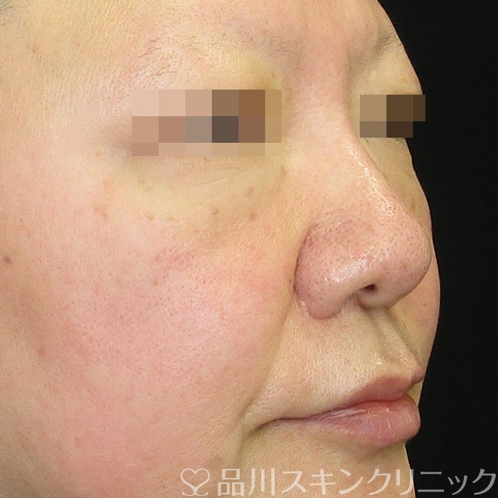 症例NO.73240のAFTER写真