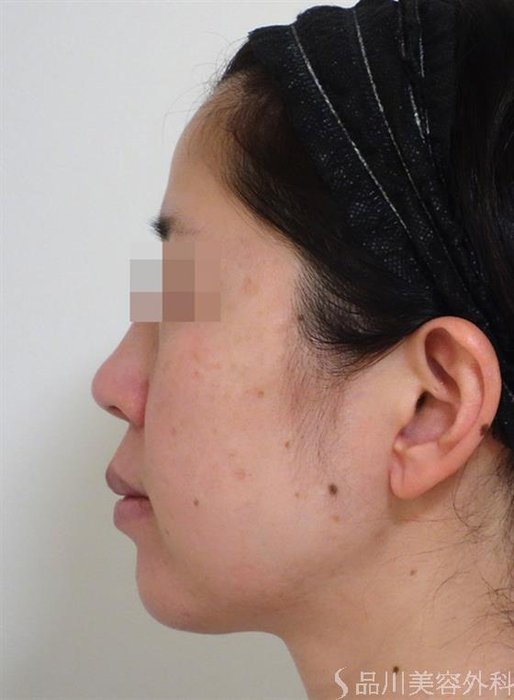 症例NO.41324のBEFORE写真